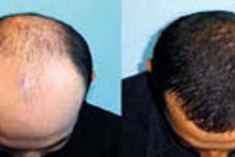 İzmit'e dev saç ekim merkezi kuruluyor!